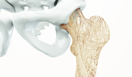 Zusammenhang zwischen Dosierung und Potenz von Statinen mit Osteoporose nachgewiesen