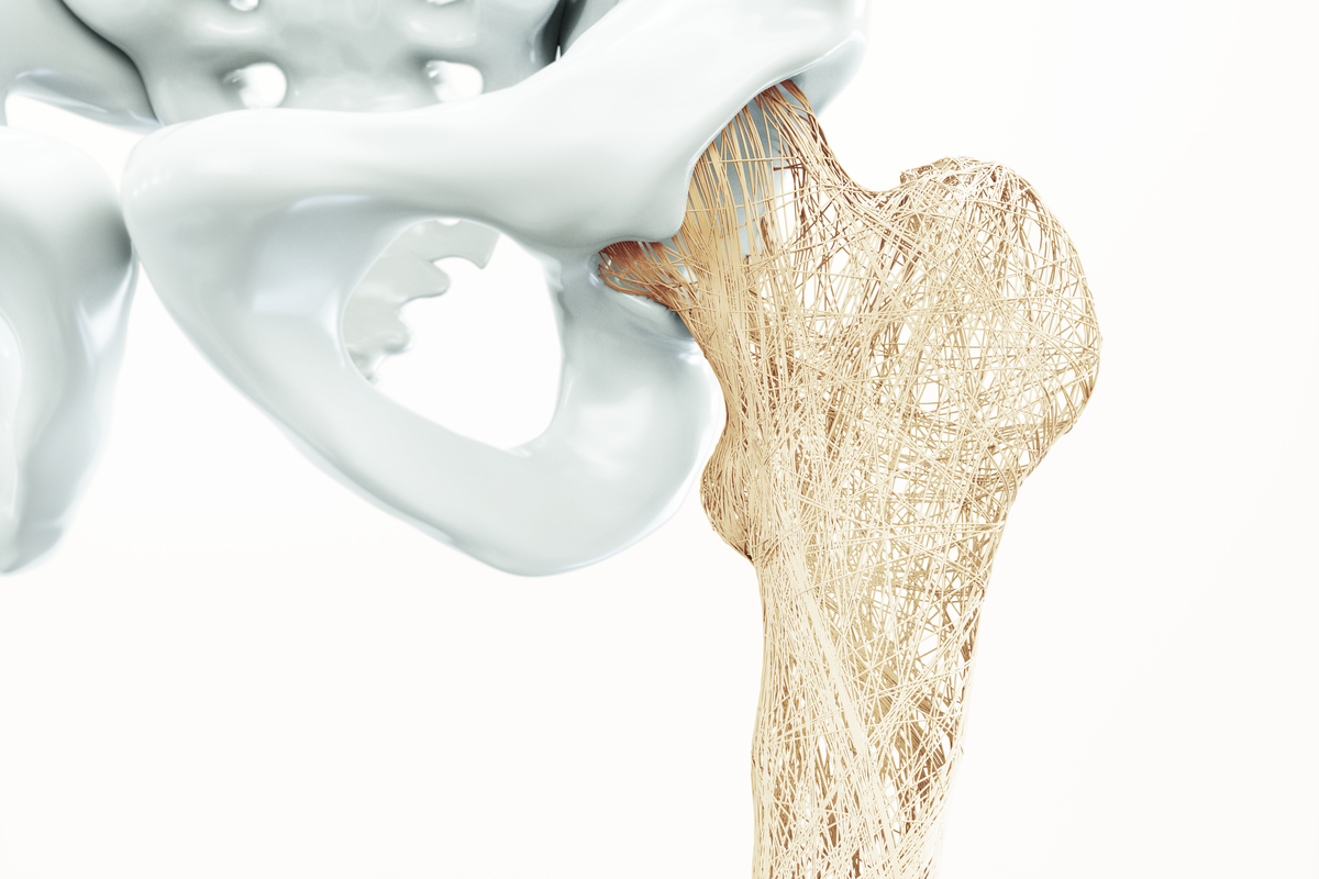 Zusammenhang zwischen Dosierung und Potenz von Statinen mit Osteoporose nachgewiesen