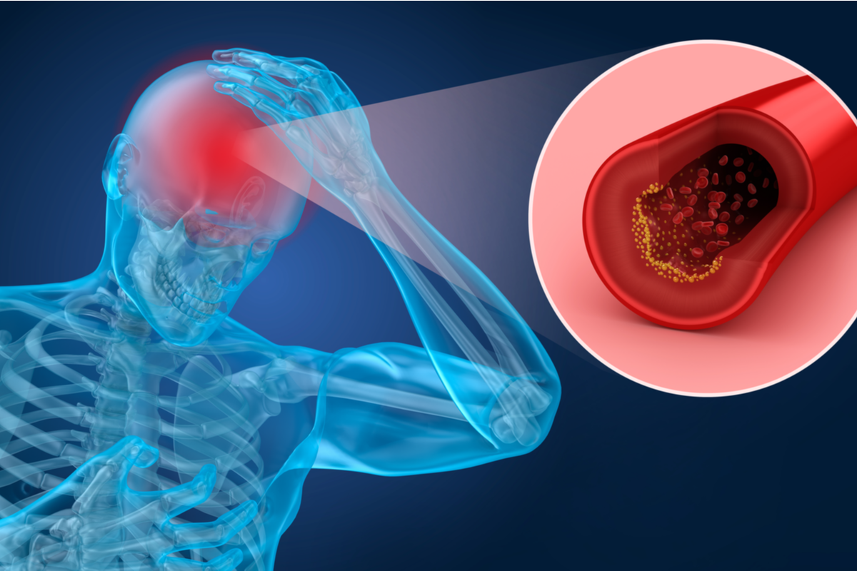 Thrombolyse: bei manchen Patienten längere Therapiezeitfenster möglich