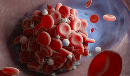 Welt-Thrombose-Tag am 13. Oktober: Thrombosen sind zweithäufigste Todesursache bei Krebs
