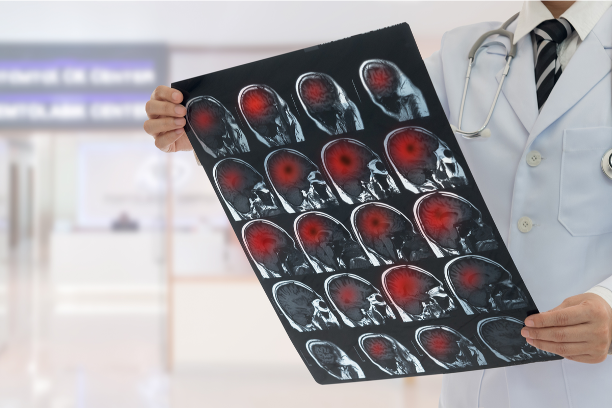 Welt-Schlaganfall-Tag: Diagnose und Therapie wird immer besser