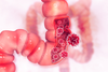 Unerwartete Rolle des Proteins mTORC2 bei Darmkrebs