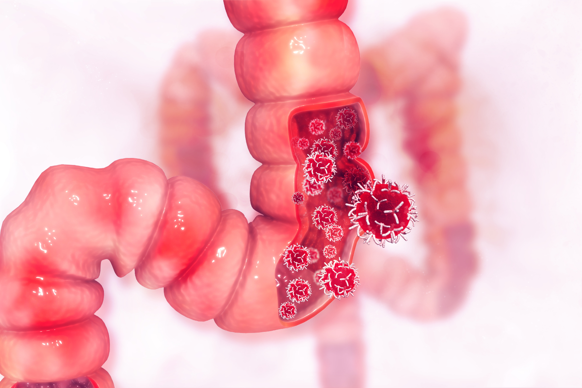 Unerwartete Rolle des Proteins mTORC2 bei Darmkrebs
