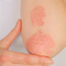 Genetische Veränderung in den Haut-Stammzellen kann Psoriasis auslösen