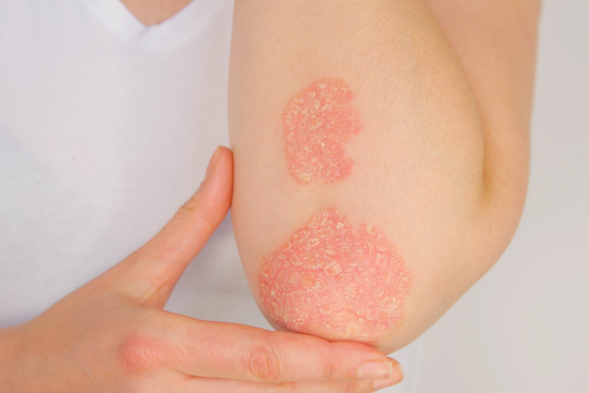 Genetische Veränderung in den Haut-Stammzellen kann Psoriasis auslösen
