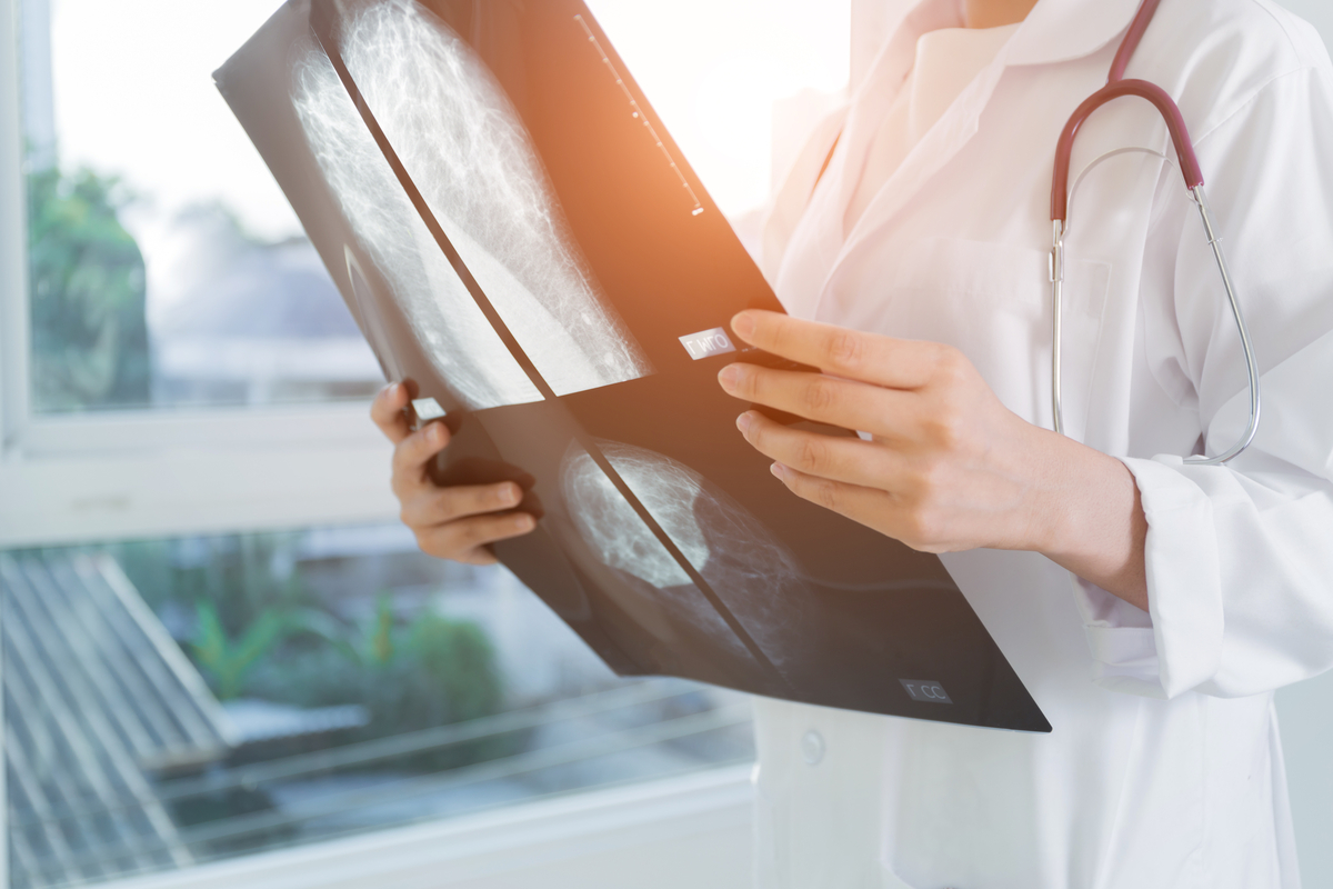 Metastasierter Brustkrebs: Entwicklung weg von Chemotherapie