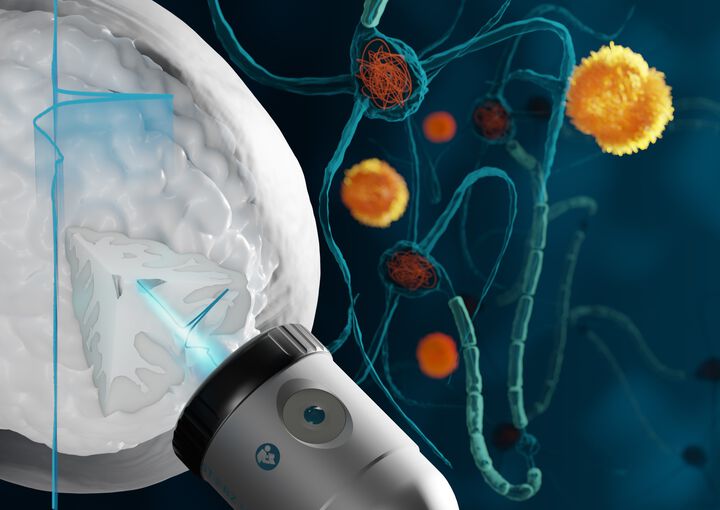 Alzheimer: Mit neuer Ultraschall-Methode die Gehirnleistung deutlich verbessern