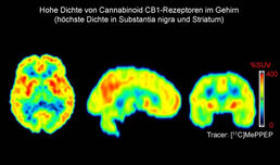Erstmals nachgewiesen: zugelassenes Cannabinoid lindert Symptome bei Parkinson