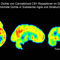 Erstmals nachgewiesen: zugelassenes Cannabinoid lindert Symptome bei Parkinson