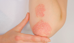 Neuer Faktor für die Entstehung von Psoriasis entschlüsselt