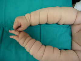 Ursachen für "Michelin Reifen Baby" Syndrom entdeckt