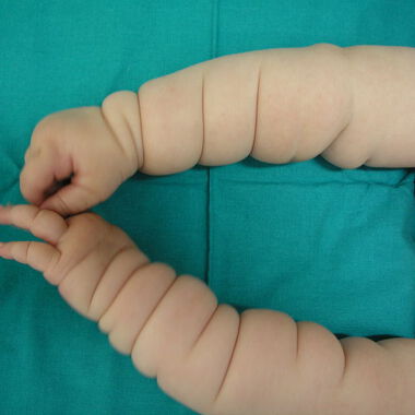 Ursachen für "Michelin Reifen Baby" Syndrom entdeckt