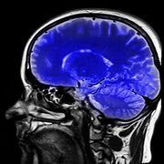 Neue vielversprechende Alzheimer Impfung erforscht