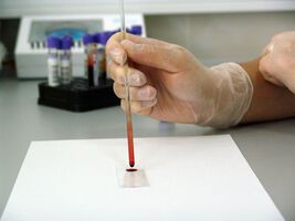 Neuer Bluttest kann Präeklampsie bei Schwangeren exakt prognostizieren