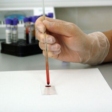 Neuer Bluttest kann Präeklampsie bei Schwangeren exakt prognostizieren