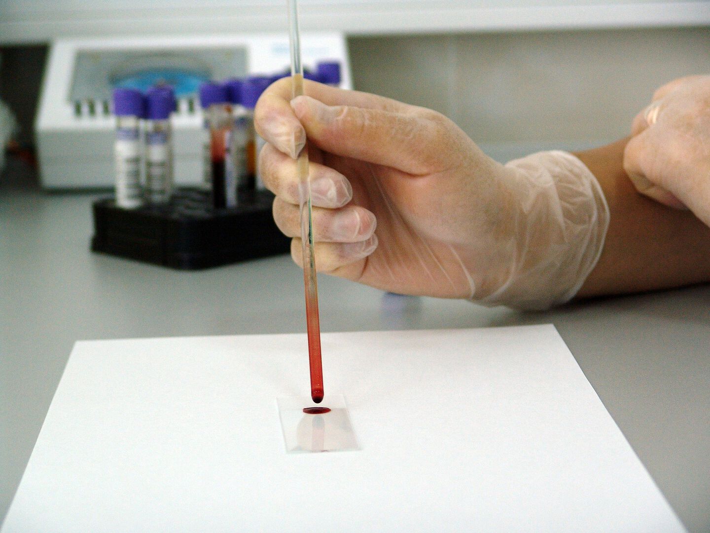 Neuer Bluttest kann Präeklampsie bei Schwangeren exakt prognostizieren
