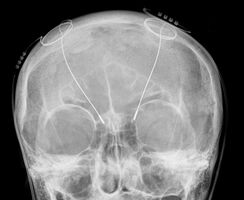 Parkinson - Neuer Ansatz könnte die tiefe Hirnstimulation verbessern