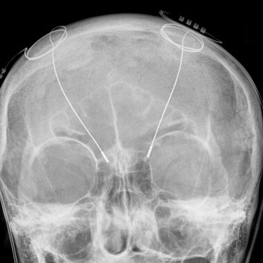 Parkinson - Neuer Ansatz könnte die tiefe Hirnstimulation verbessern