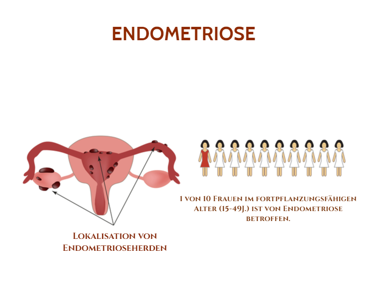 Viele Frauen im reproduktionsfähigen Alter sind von Endometriose betroffen.