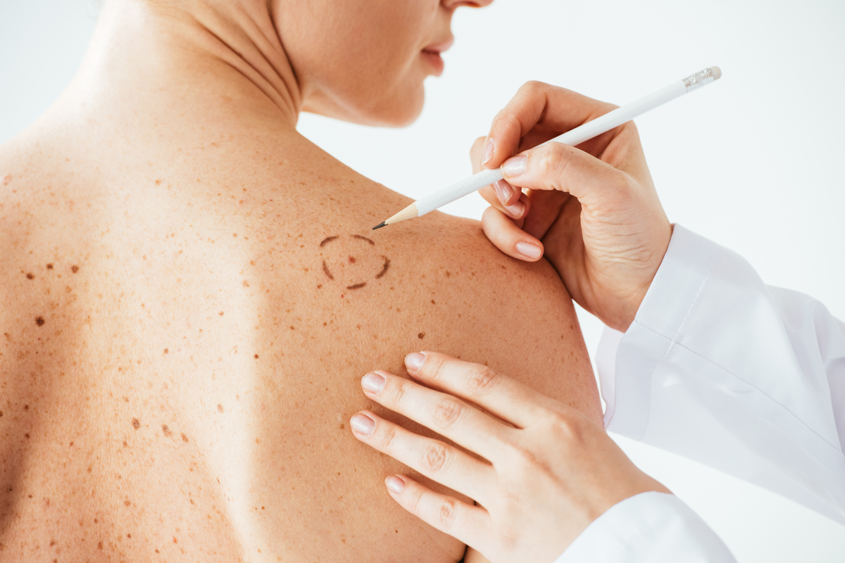 Melanom – Ursache, Diagnose und Therapie