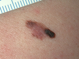 Melanom – Ursache, Diagnose und Therapie