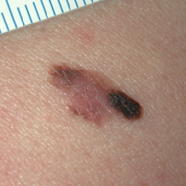Melanom – Ursache, Diagnose und Therapie