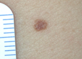 Melanom – Symptome, Aussehen und Diagnose