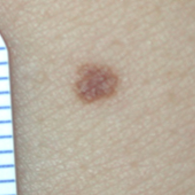 Melanom – Symptome, Aussehen und Diagnose