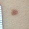 Melanom – Symptome, Aussehen und Diagnose