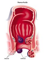 OP erfolgreich? Das Auftreten von Hämorrhoiden ist ein Prädiktor