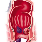 OP erfolgreich? Das Auftreten von Hämorrhoiden ist ein Prädiktor