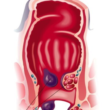 OP erfolgreich? Das Auftreten von Hämorrhoiden ist ein Prädiktor