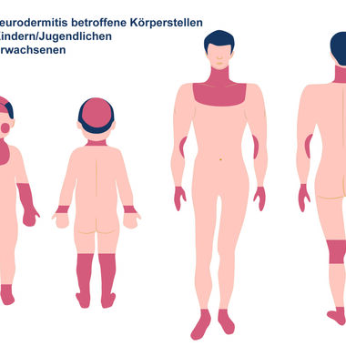 Neurodermitis, was ist neu, was ist Bewährtes?
