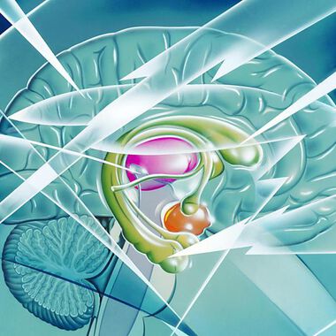 Auch scheinbar gesundes Gehirngewebe spielt bei Epilepsie eine Rolle