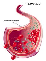 Körperliche Inaktivität erhöht das Thromboserisiko
