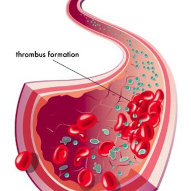 Körperliche Inaktivität erhöht das Thromboserisiko