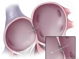Diastolische Herzschwäche - Implantierte Spange als neues Therapieverfahren