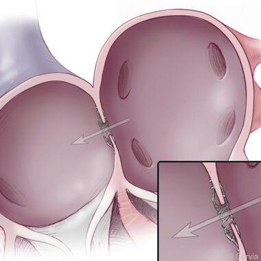 Diastolische Herzschwäche - Implantierte Spange als neues Therapieverfahren