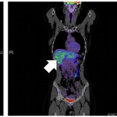 Darmkrebs: Metastasen "missbrauchen" das Immunsystem