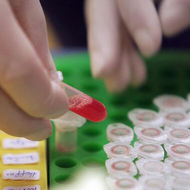 Aminosäure als Biomarker für die Herzinfarktgefahr