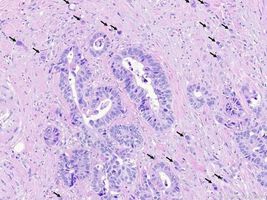 Schweizer Froscher erarbeiten exakten Diagnosestandard für Dickdarmkrebs