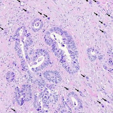 Schweizer Froscher erarbeiten exakten Diagnosestandard für Dickdarmkrebs