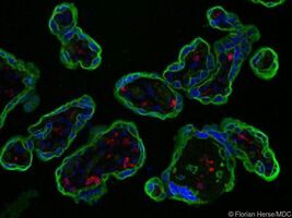 Bei Präeklampsie ist wichtiges Immunprotein der Plazenta verringert