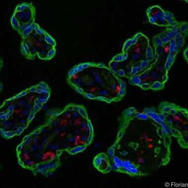 Bei Präeklampsie ist wichtiges Immunprotein der Plazenta verringert