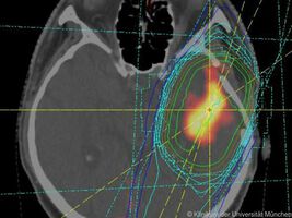 Neue Biomarker geben Hinweise für Krankheitsverlauf von Glioblastomen
