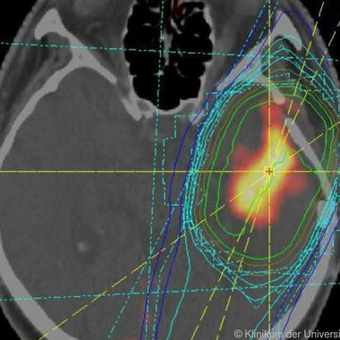 Neue Biomarker geben Hinweise für Krankheitsverlauf von Glioblastomen