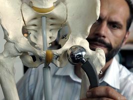 Metallionen aus Hüftimplantate können zu Knochenverlust führen