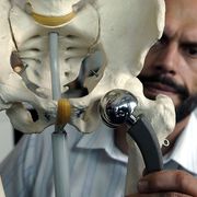 Metallionen aus Hüftimplantate können zu Knochenverlust führen