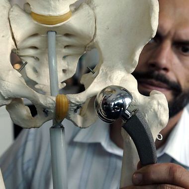 Metallionen aus Hüftimplantate können zu Knochenverlust führen