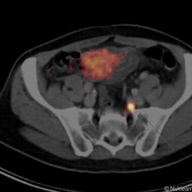 Neue Methode zeigt die kleinsten Metastasen beim Prostatakrebs